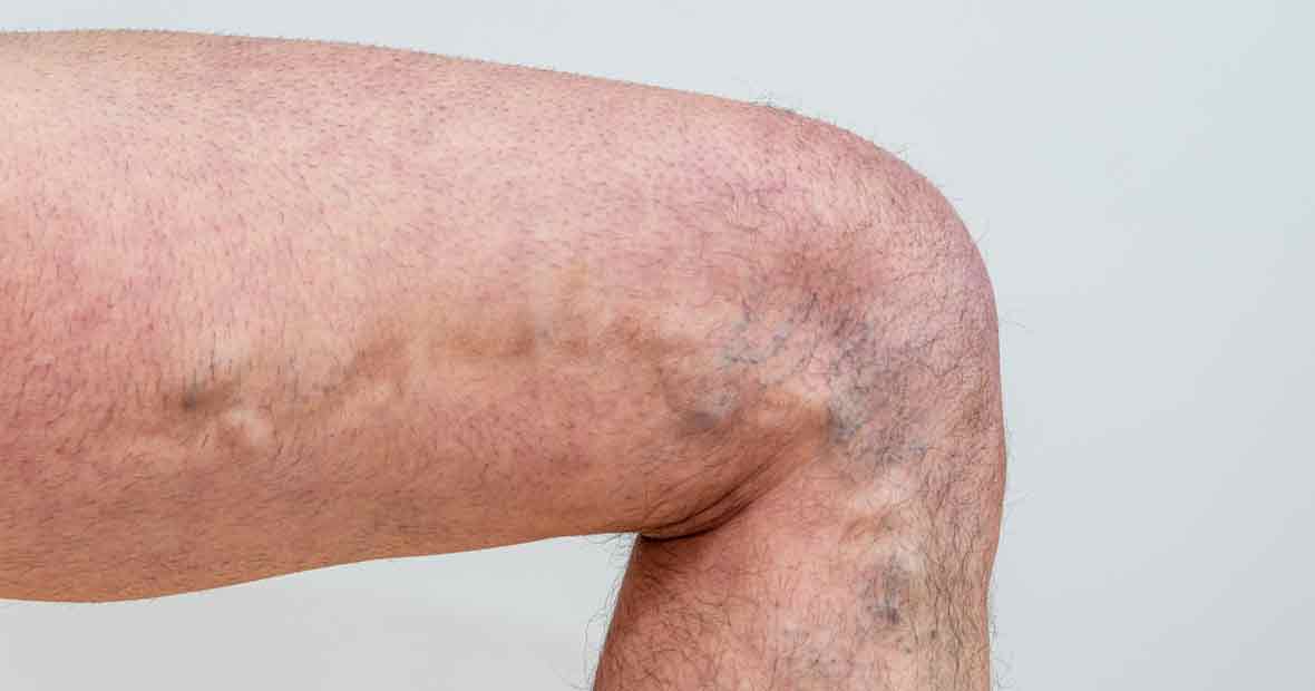 pathologies veineuses